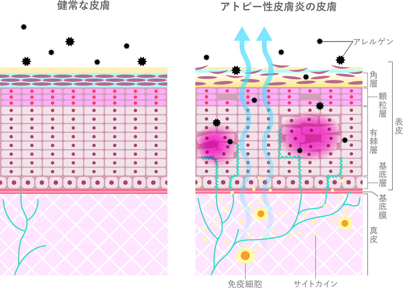 アトピー性皮膚炎は肌のバリア機能が低下し、アレルギーの原因物質であるダニ、ハウスダスト、埃、食物などのアレルゲンが侵入しやすくなり、炎症を引き起こします。かゆみを感じる神経が皮膚の表面まで伸びてきて、かゆみを強く感じると皮膚をかき壊してしまうことで、さらに皮膚のバリア機能が低下するという悪循環に陥りやすく、また、バリア機能が低下しているため、肌から水分が蒸発しやすくなってしまいます。